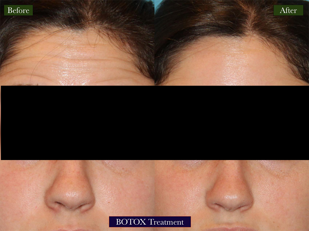 BOTOX Treatment